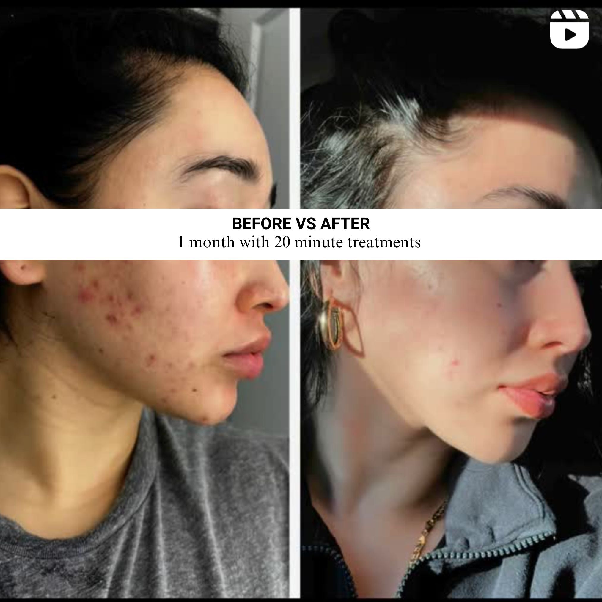 VISO - Mascarilla de terapia de luz roja certificada por la FDA
